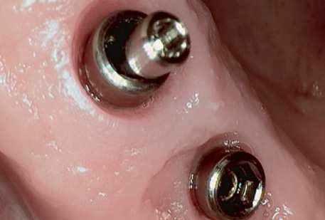 MIMI®-Flapless: Implantation gleich im Anschluss an eine Zahnextraktion